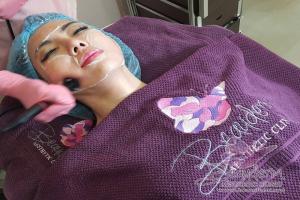 Facelifting With Radio Frequency