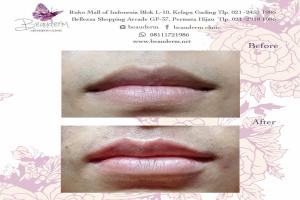 Lips Filler / Filler Bibir