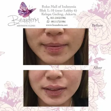 gallery img: Lips Filler / Filler Bibir