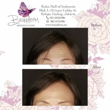 gallery img: Perawatan Injection Dahi