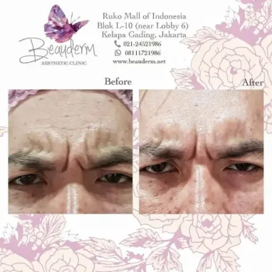 gallery img: Perawatan Injection Dahi