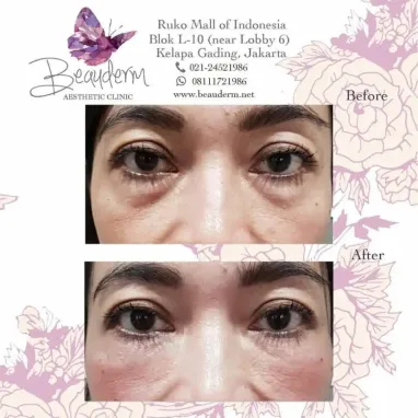 gallery img: Under Eye Filler