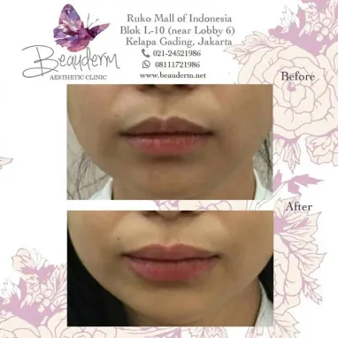 gallery img: Lips Filler / Filler Bibir