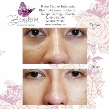 gallery img: Filler Hidung / Nose Filler