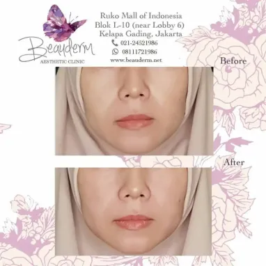 gallery img: Smile Line Filler