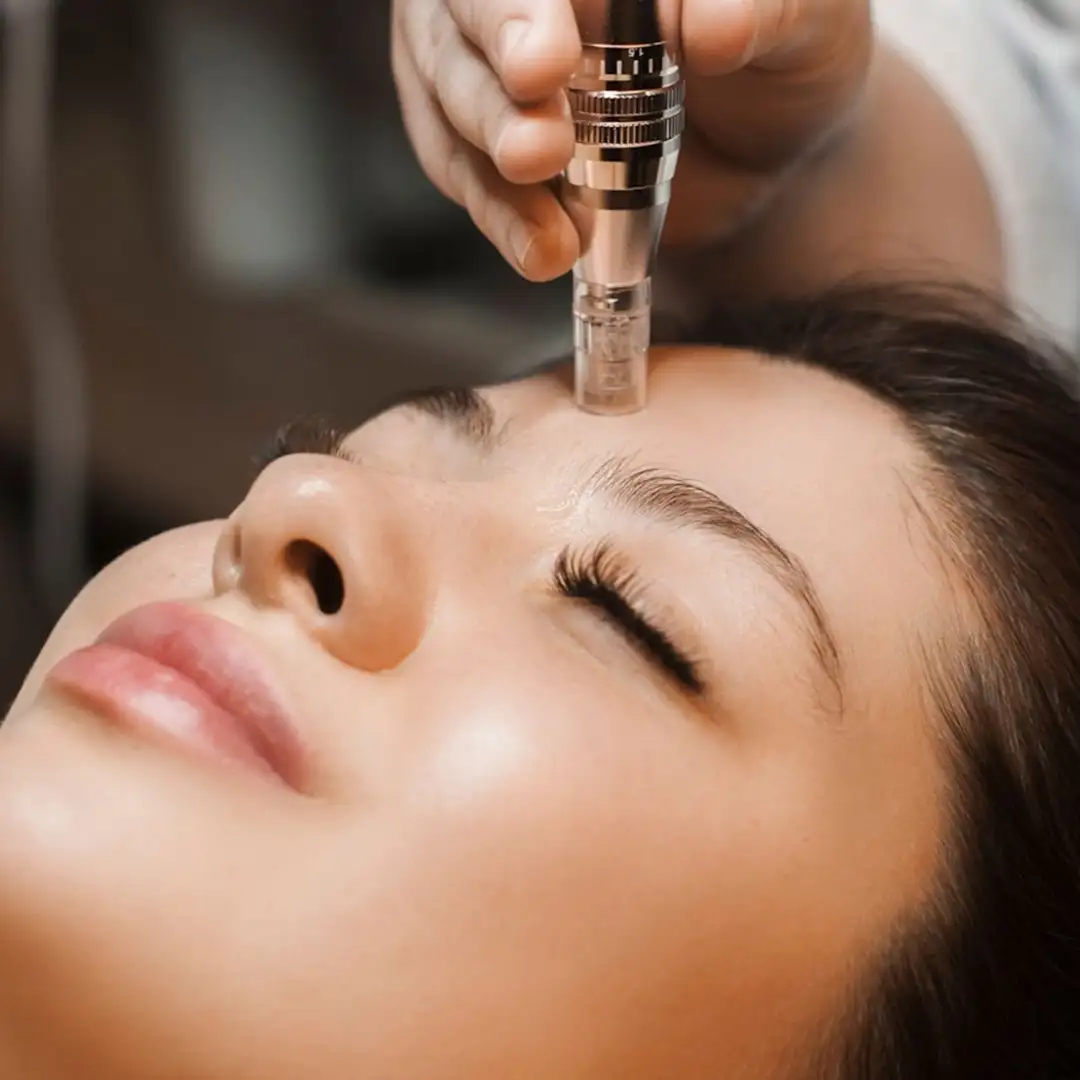 Collagen Induction Therapy / Microneedling Menggunakan Dermaroller