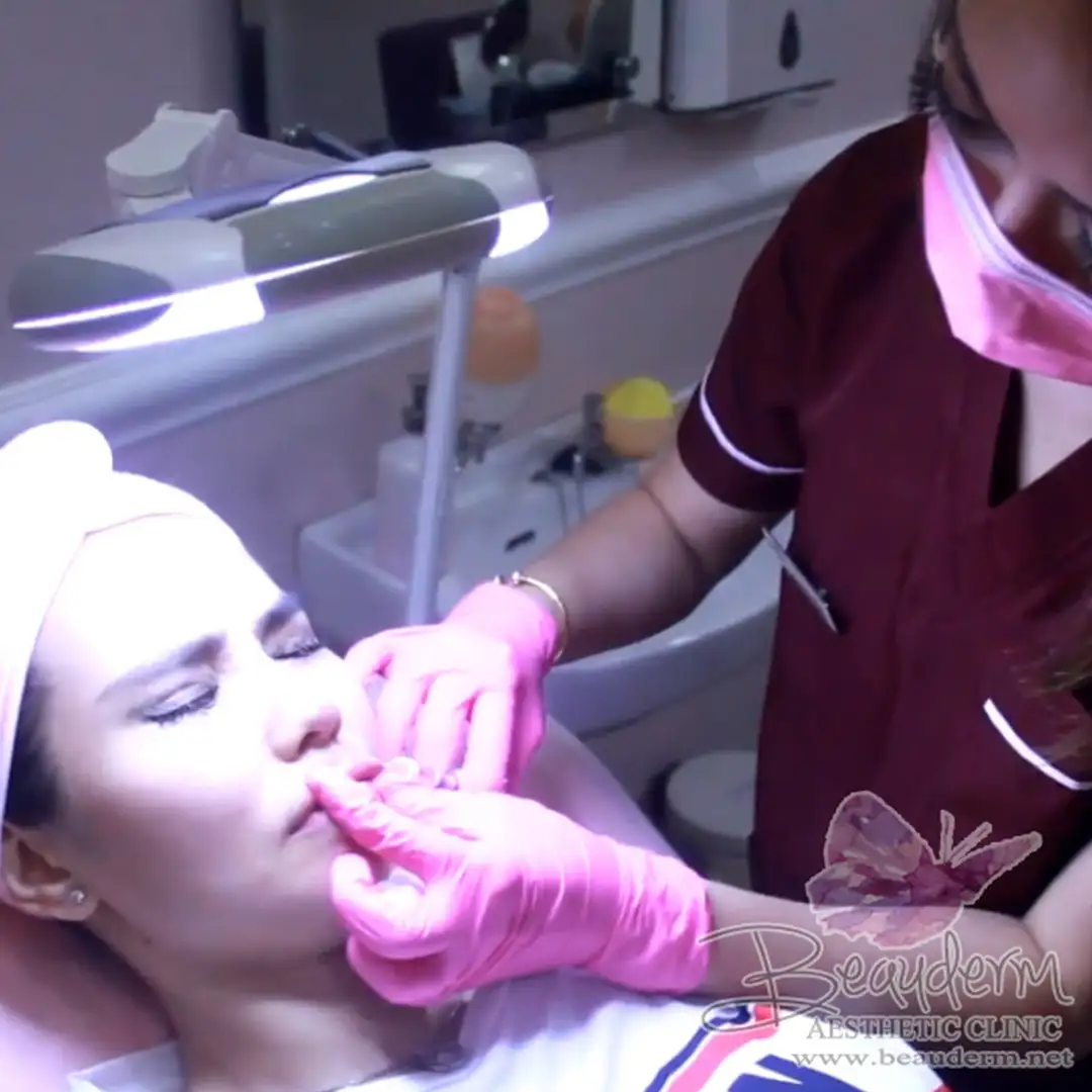 Cece Bakmi - Perawatan Suntik Filler Bibir