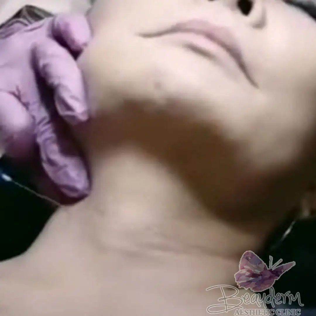 Neck Rejuvenation