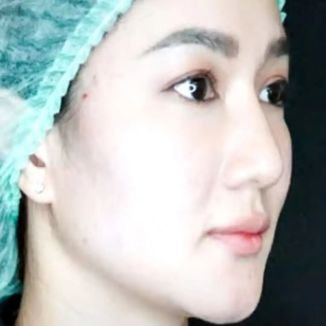 Jenis Benang yang Tepat, Perawatan Tarik Benang (Threadlift)