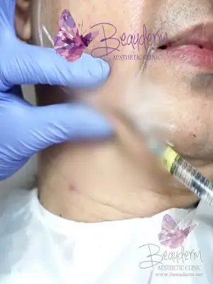 Filler Garis Rahang Bentuk Lebih Ideal Maskulin Feminin (Jawline)