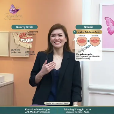 Botox Bisa Atasi Gummy Smile? Cek Faktanya!
