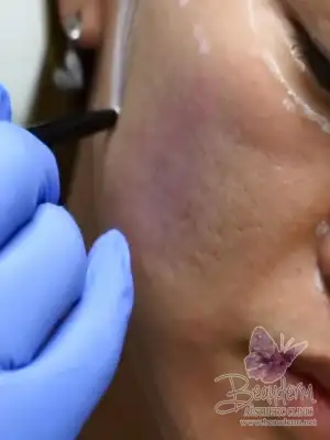 Collagen Stimulator Injection - Aesthetics