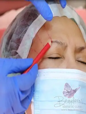 Eyebrow Thread Lifting, Metode Mengangkat Kelopak Mata Atas