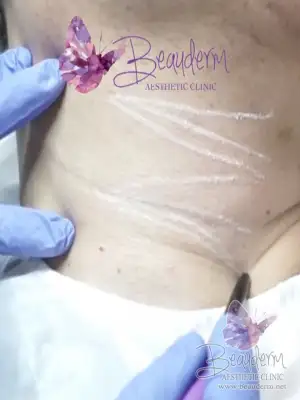 Peremajaan Kulit Keriput Leher Agar Tetap Lembab Kencang