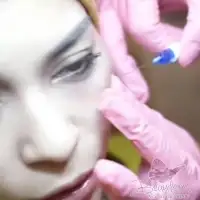 Under Eye Filler Treatment