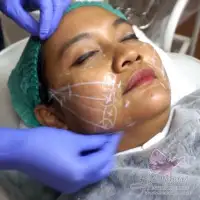 Perawatan Kecantikan Tarik Benang untuk Pipi Kendur