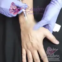 Keriput Pada Punggung Tangan Hilangkan Dengan Filler Hand Rejuvenation