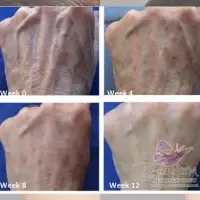 Perawatan Peremajaan Kulit (Skin Rejuvenation) Agar Tampak Awet Muda