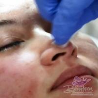 Suntik Filler Hidung Di Jakarta - Aesthetic Clinic