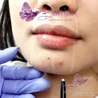Augmentasi Chin Filler Memperbaiki Bentuk Ukuran Dagu