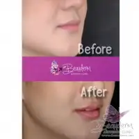 Suntik Filler Bibir Before After, Melembabkan Mengurangi Kerutan