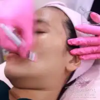 Treatment Glowing Chemical Peeling atau Chemical Peel for Acne