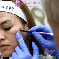 Perawatan Ini Dapat Meniruskan Pipi Chubby atau Pipi Tembem Pada Wajah