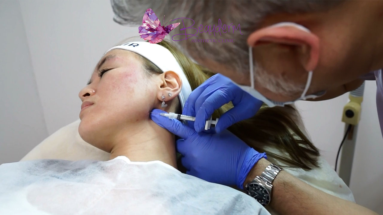 Mandibular Angle Biostimulator Injections